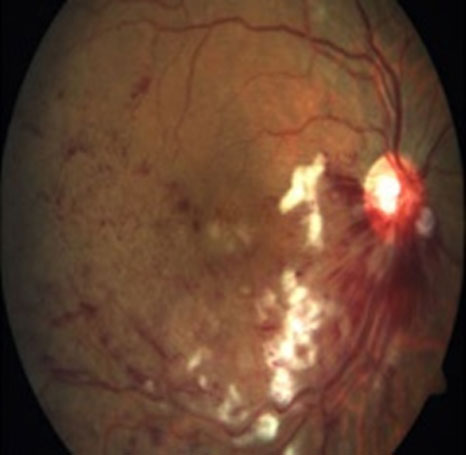 Retinal Vein occlusion