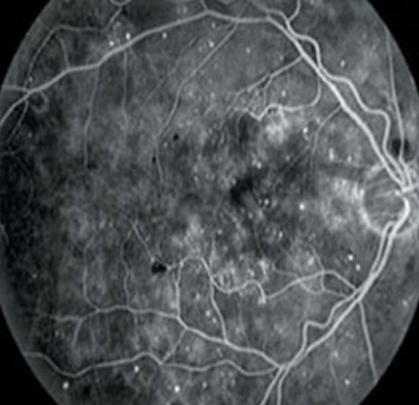Fundus Fluorescein Angiography